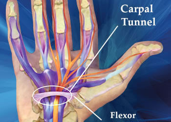 Can Carpal Tunnel Syndrome be Treated by Chiropractic Care?