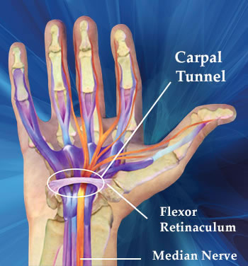 Carpal Tunnel Syndrome