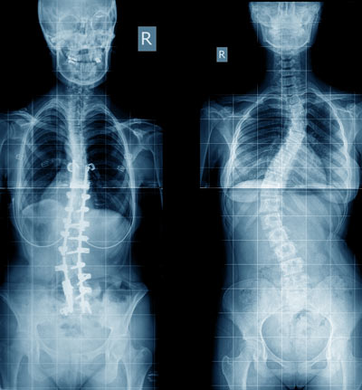 Chiropractic Care and Scoliosis