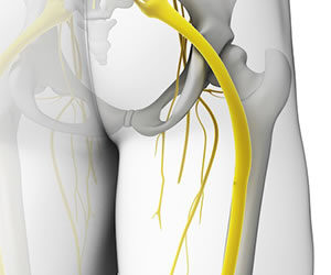 Chiropractic Treatment of Sciatica and Sciatic Nerve Pain Lower Back and/or Leg Pain