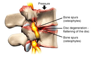 Degenerative Disc