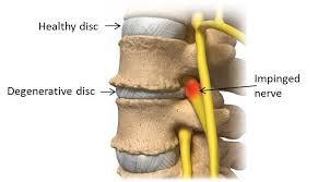 Impinged Nerve