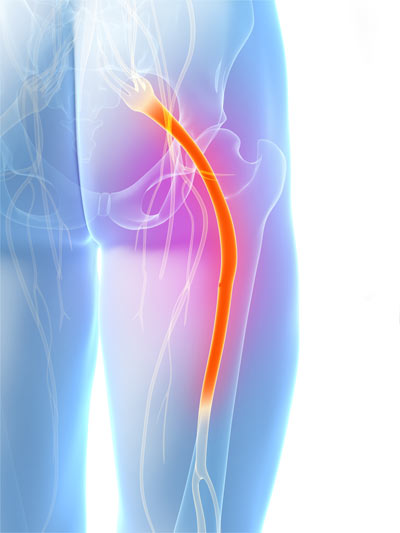 Leg Pain Sciatic Nerve