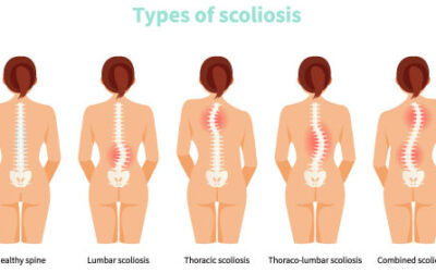 Scoliosis and Chiropractic Care