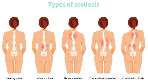 Scoliosis and Chiropractic Care