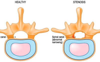 Spinal Stenosis