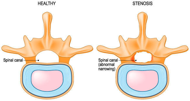 Spinal Stenosis Chiropractic Care